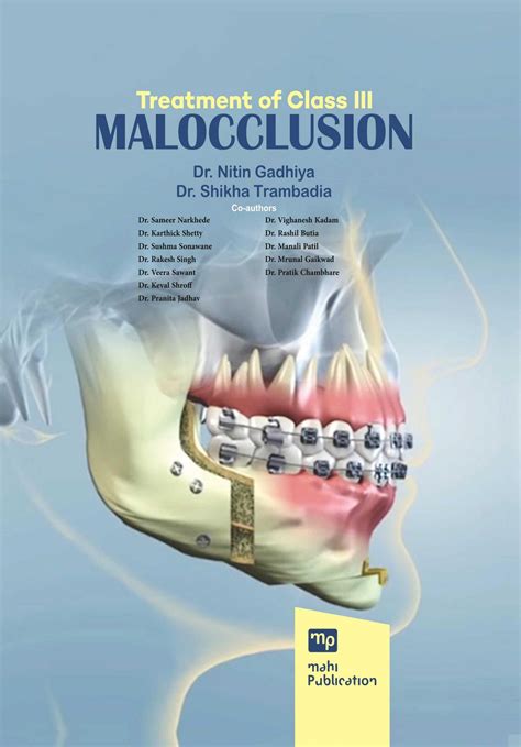 Treatment Of Class III Malocclusion Dr Nitin Gadhiya Dr Shikha