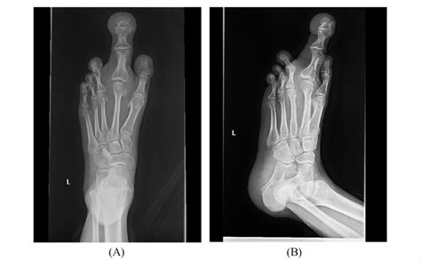 Plain Films A Anterior Posterior B Oblique Radiographic Images