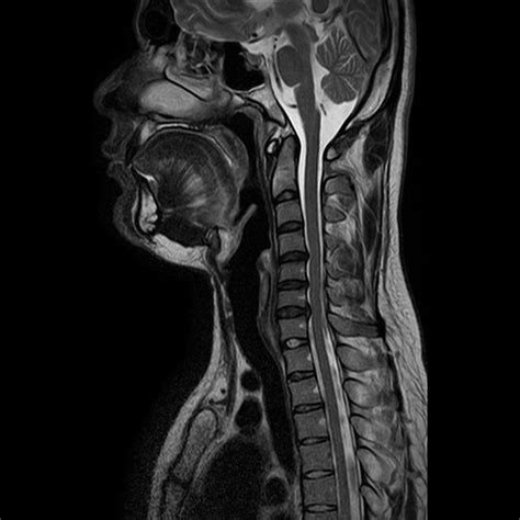 Brachial Plexus Injury Image Radiopaedia Org