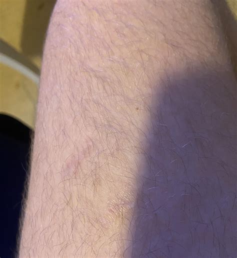 Dog bite update after a year, barely visible : r/scars