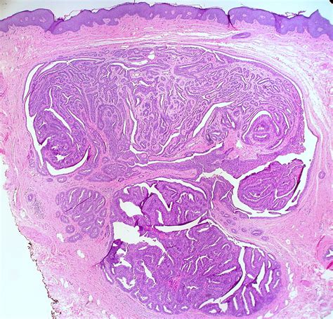 Hidradenoma Papilliferum Of The Vulva A Photo On Flickriver