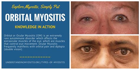 Orbital Myositis Om Myositis Support And Understanding