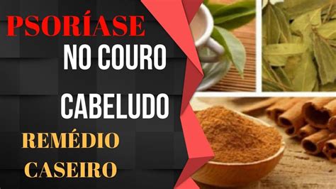 Psoríase No Couro Cabeludo Remédio Caseiro Inusitado YouTube