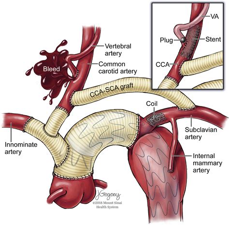 Carotid Subclavian Transposition