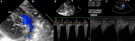 Right To Left Shunt Across The Patent Ductus Arteriosus Pda A Download Scientific Diagram