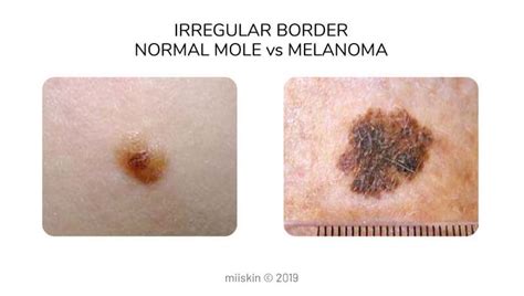 Cancerous Moles Vs Normal Moles