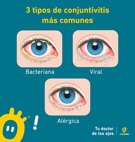 Conjuntivitis Síntomas y tratamiento salauno