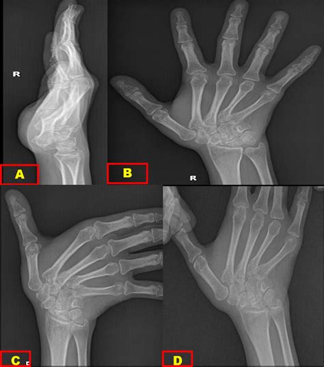 A Plain Radiograph Of Hand And Wrist Lateral View Showing Multiple