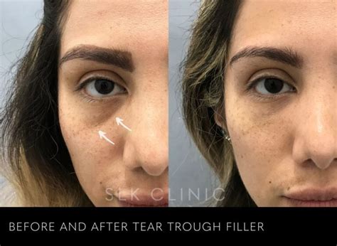 Filler Before And After Photos Slk Clinic