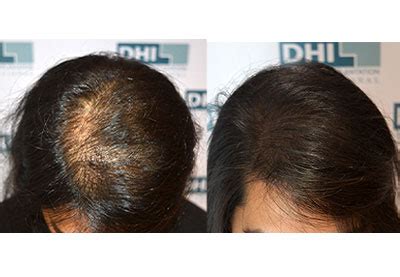 What Is The Best Treatment For Female Hair Loss - Infoupdate.org