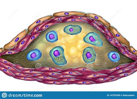 Structure of Atherosclerotic Plaque Stock Illustration - Illustration ...