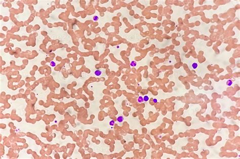 Photomicrograph of hematological slide showing monocytosis. Abnormal monocyte. 14261284 Stock ...