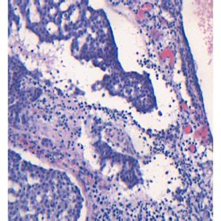 A Cribriform Pattern Of Apocrine Adenocarcinoma Original