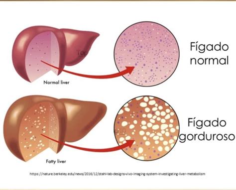 Gordura no Fígado entenda o que é a ESTEATOSE HEPÁTICA Vivendo Clínica