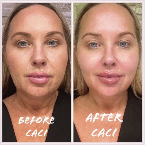 Benefits Of A Caci Synergy