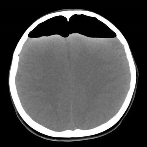 Tension Pneumocephalus From Endoscopic Endonasal Surgery A Case Serie