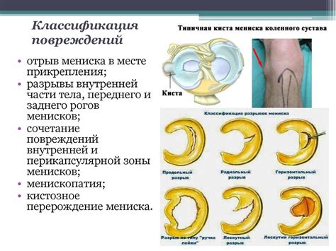 Повреждение мениска коленного сустава: симптомы и лечение