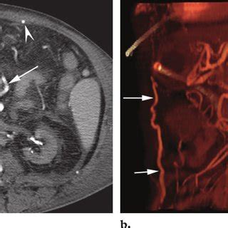 Total occlusion of the infrarenal abdominal aorta. (a)... | Download ...