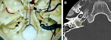 Jugular Foramen Syndrome