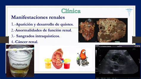 Poliquistosis Renal Autosomica Dominante Ppt