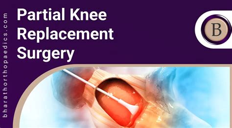 Partial Knee Replacement Surgery 100 Best Treatment