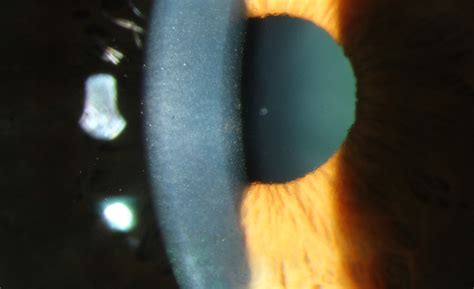 Fuchs corneal endothelial dystrophy