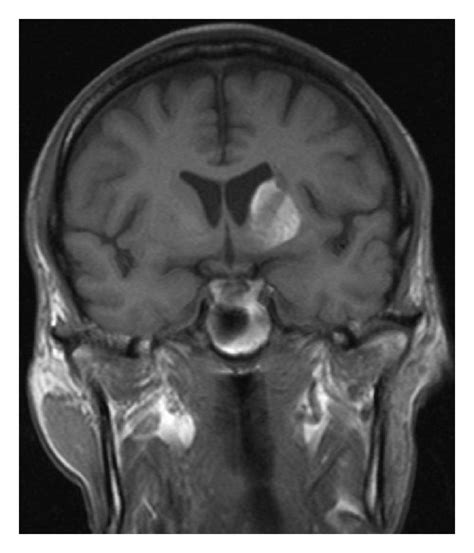 MRI changes in the left corpus striatum related to hemichorea... | Download Scientific Diagram