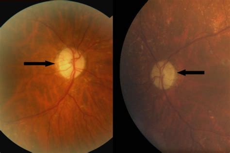 Fundus Examination The First Image Represents The Patients Right Eye Download Scientific