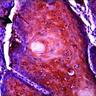 Photomicrograph Of Well Differentiated Squamous Cell Carcinoma Showing