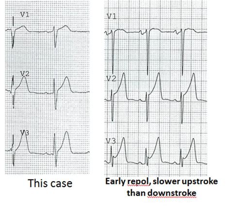 Dr Smiths Ecg Blog Acute Mi From Lad Occlusion Or Early Repolarization