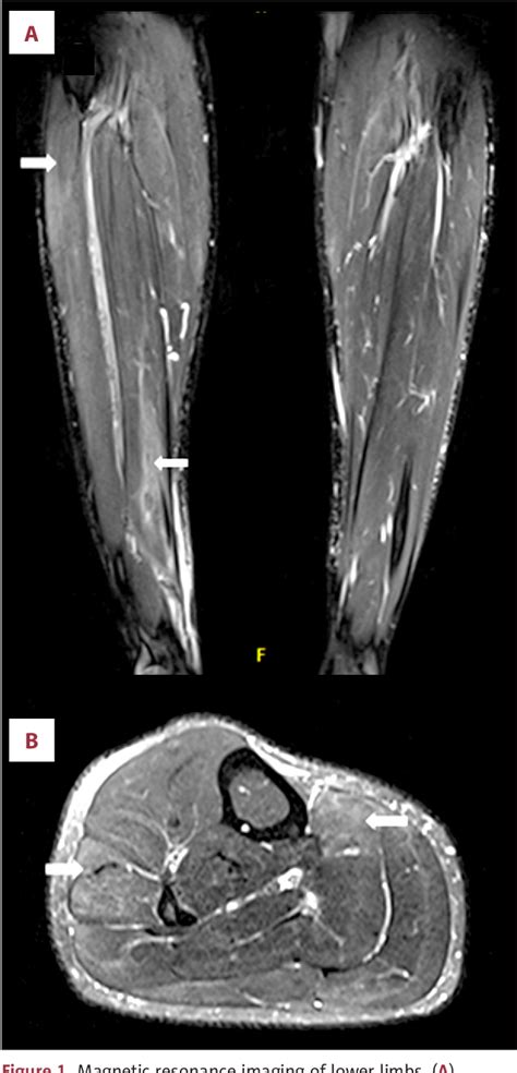 Figure From Myositis Induced By Isotretinoin A Case Report And