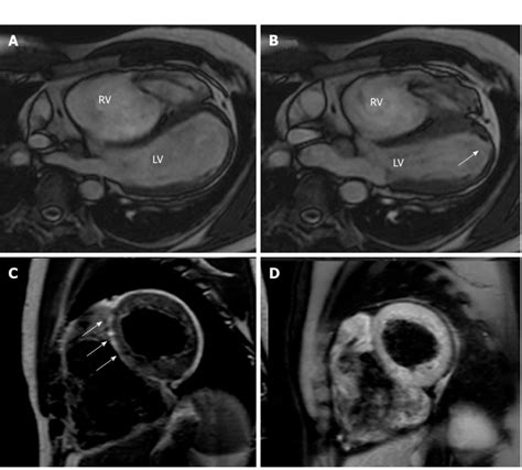 Cardiac Magnetic Resonance Images Of An Arrhythmogenic Right