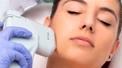 C Mo Hacer Lifting Facial A Tus Pacientes Con Hifu