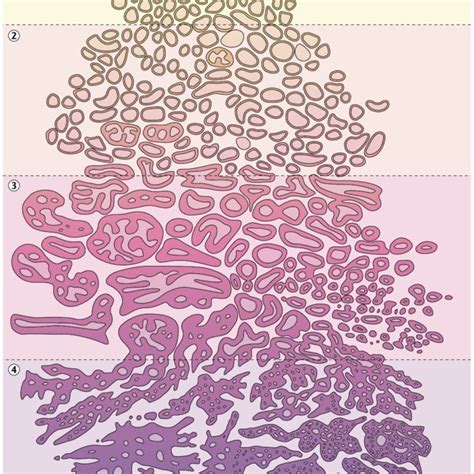 The Prostate Cancer Grading And Scoring System Developed By Gleason