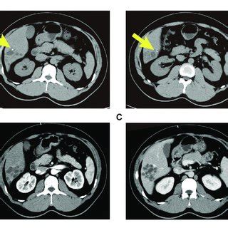 Abdominal Contrast Enhanced Ct Showed An Intrahepatic Multicystic