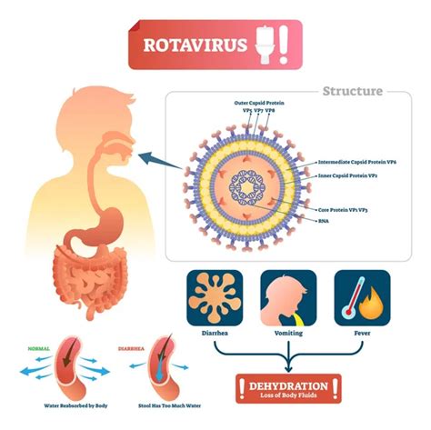 Gastroenteritis Vector Illustration Labeled Stomach Inflammation Scheme Stock Vector Image By