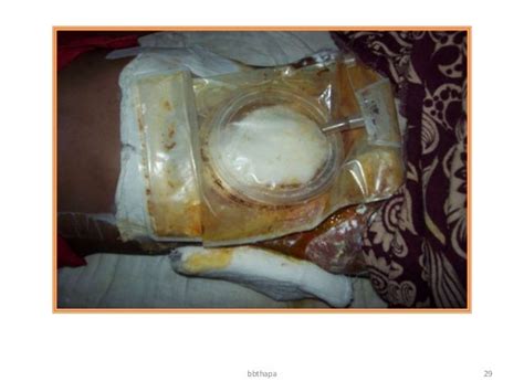 Management Of Enterocutaneous Fistula