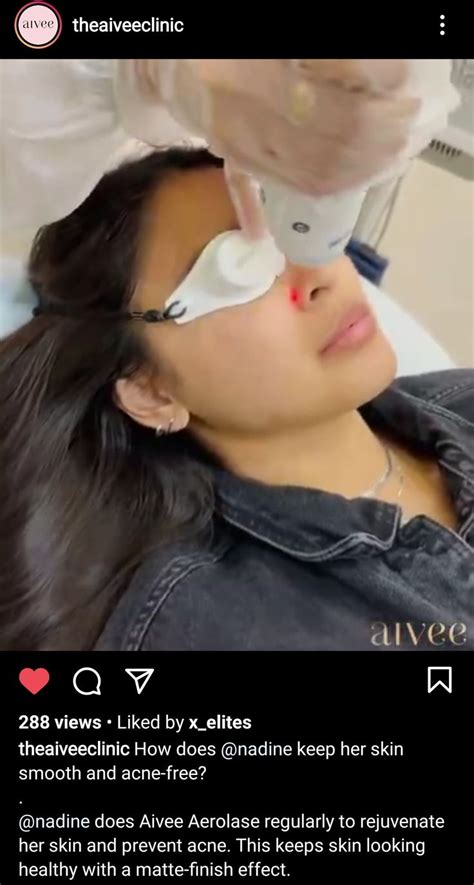 Nadine Lustre Aivee Day Acne Free Prevent Acne Skin