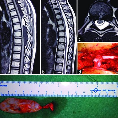 T1 Weighted Sagittal Section Of Thoracic Spine Magnetic Resonance