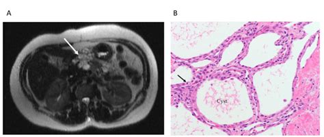 (A) MRI of serous cystadenoma; (B)-Histology of serous cystadenoma with ...