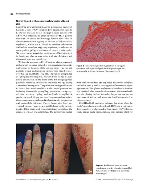 Pdf Necrolytic Acral Erythema Successfully Treated With Oral Zinc Marcelo Arnone