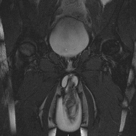 Lesion Patterns On Conventional MRI In Leukodystrophies And