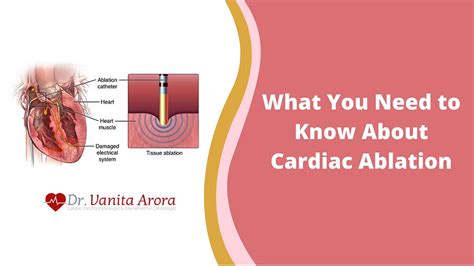 What You Need To Know About Cardiac Ablation