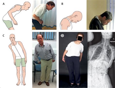 Postural Deformities In Parkinsons Disease The Lancet Neurology