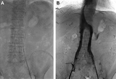 Double Inferior Vena Cava Filter Implantation In A Patient With