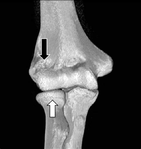 Radial head and radial fossa. In extreme flexion, the radial head... | Download Scientific Diagram