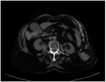 Hernia De Grynfelt Incarcerada