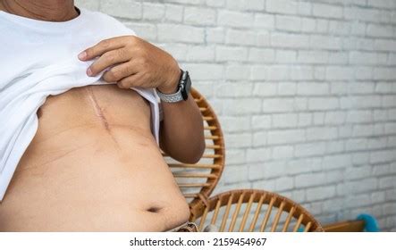 Scar Open Heart Surgery Senior Man Stock Photo 2159454967 Shutterstock