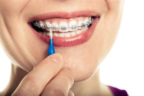 Braces Oral Hygiene Tips The Cosmetic Dental Spa