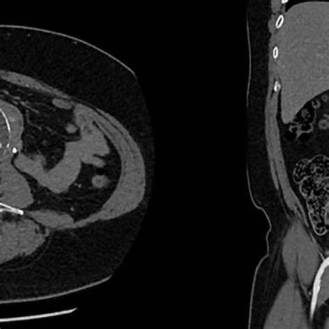 Ct Kub Showing A Large Fusiform Infra Renal Aaa With Moderate To Severe Download Scientific